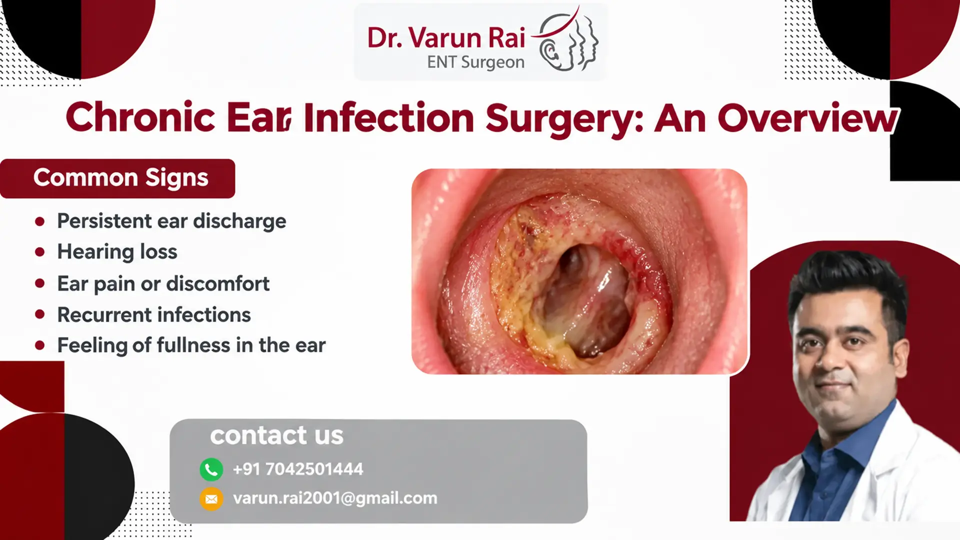 Chronic Ear Infection Surgery: An Overview