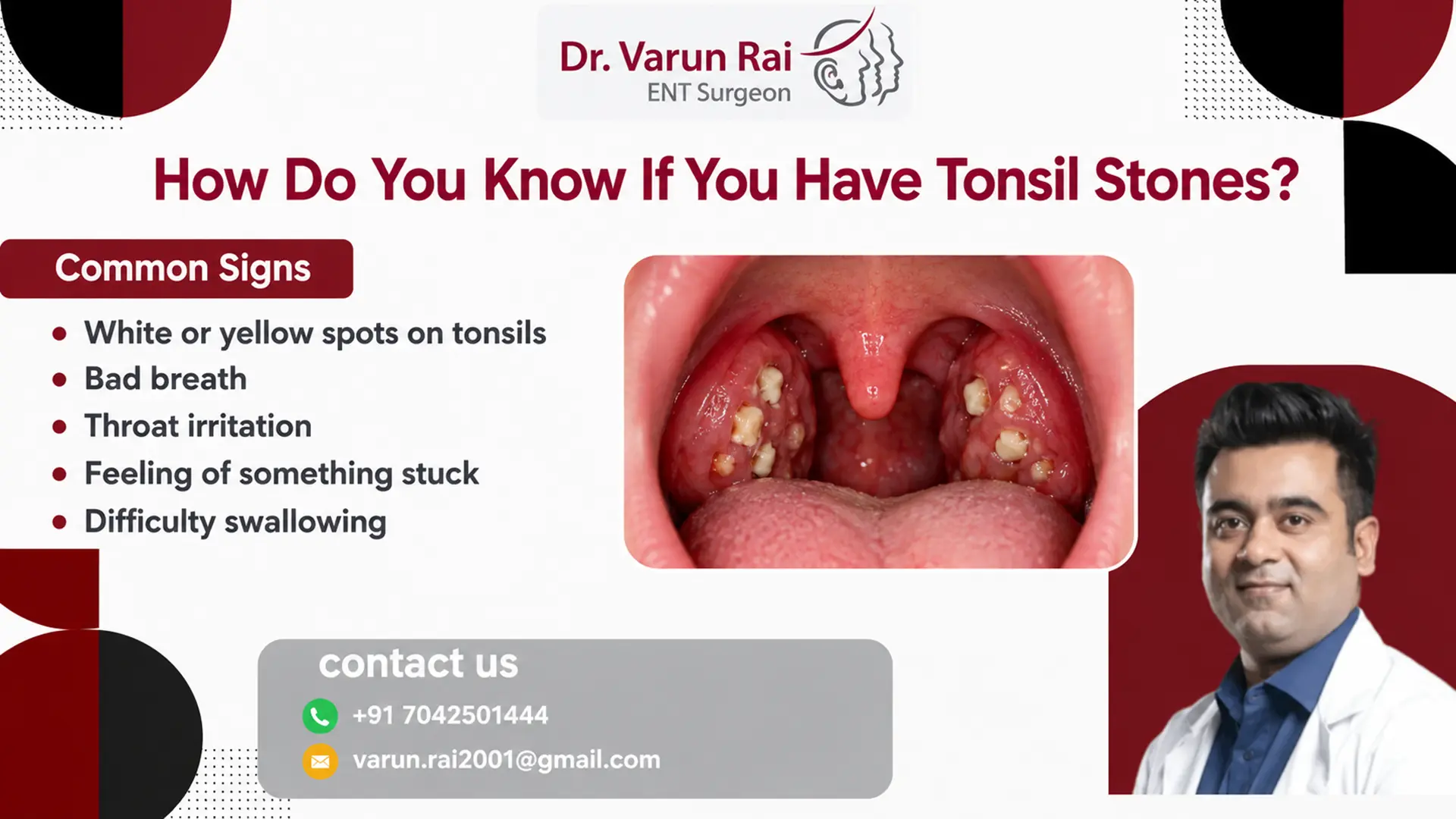 How Do You Know If You Have Tonsil Stones?